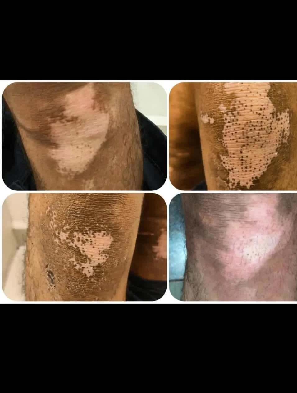 Proctology (Piles) Treatment image