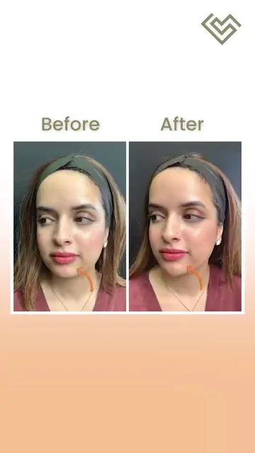 Anti-ageing Injectables image