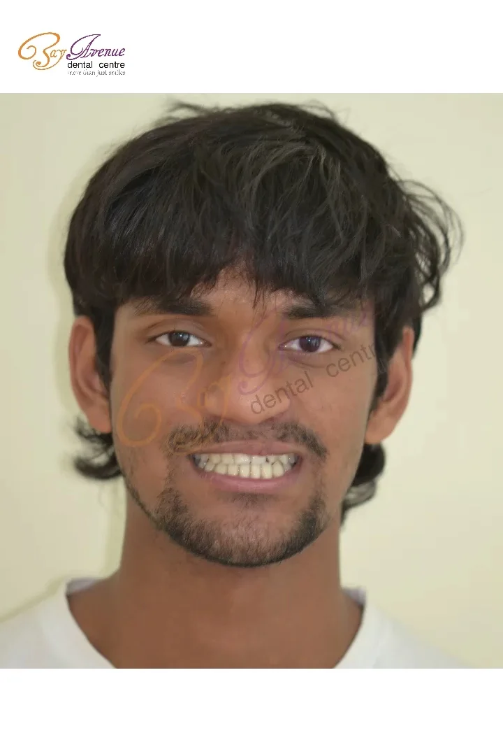 Dental Implants Consultation image
