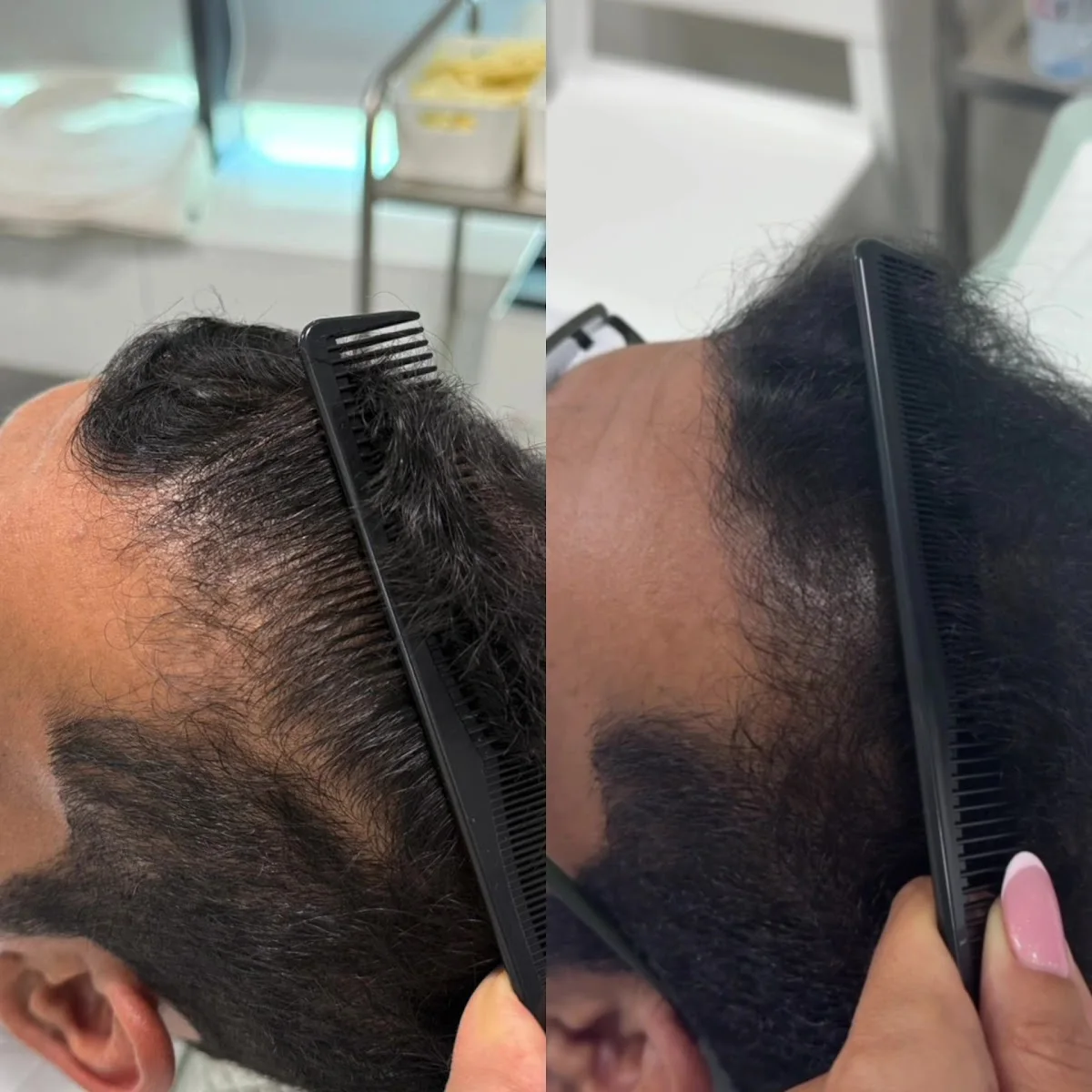 Platelet-Rich Plasma (PRP) for Hair Restoration image