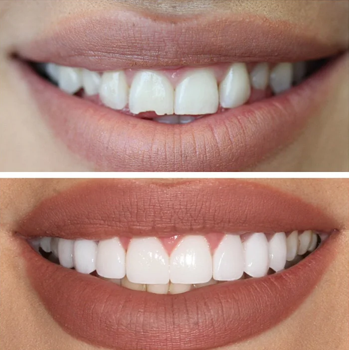 Teeth Whitening image