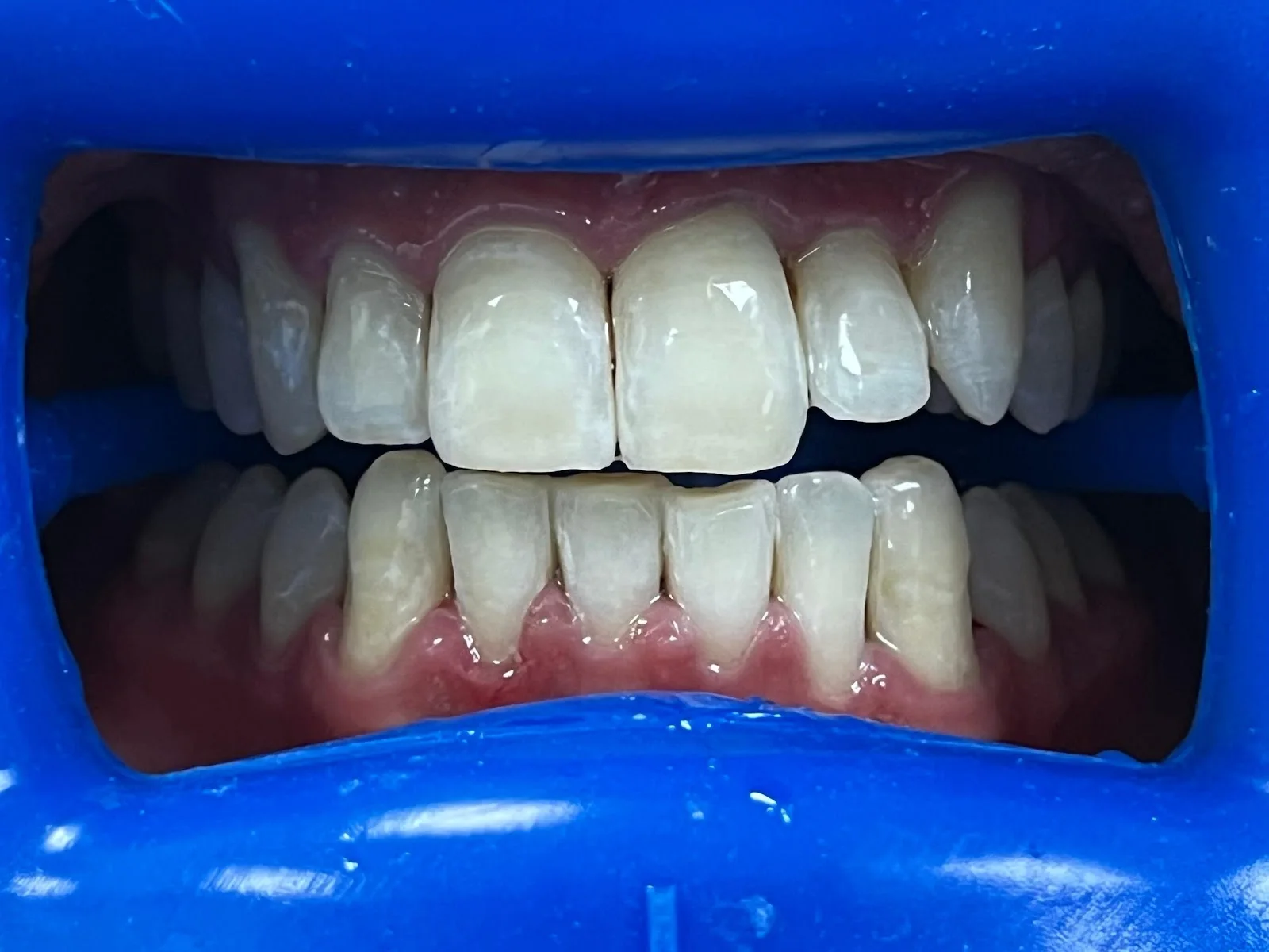 Fillings & Restorative Care image