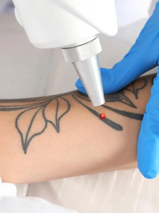 Dermal Fillers image