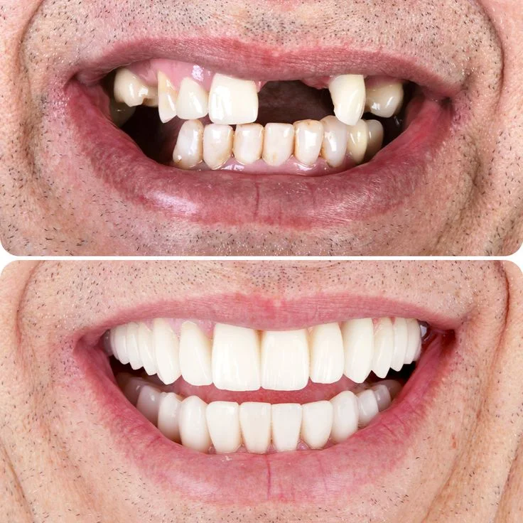 Botulinum toxin (anti-wrinkle) image
